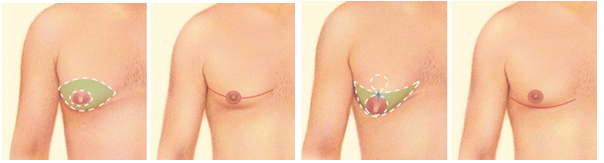male breast reduction surgery tunisia